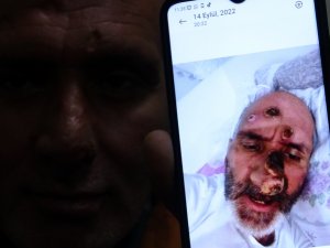 Afrika Sineğinin ısırmasıyla tanınmayacak hale geldi!