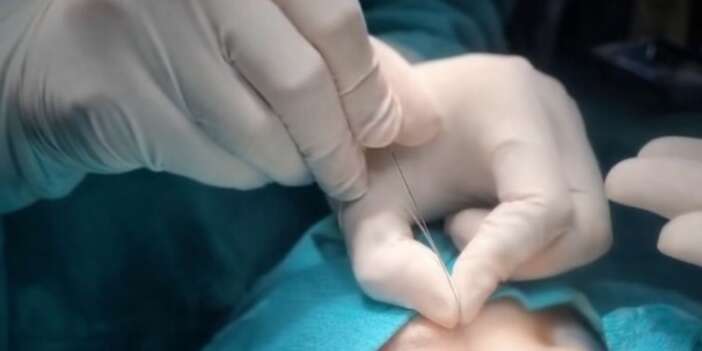 Gözyaşı kanalı ameliyatları artık Çukurca’da