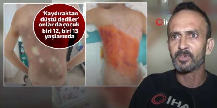 Üçüncü derece yanık oluşan çocuk için hukuk mücadelesi