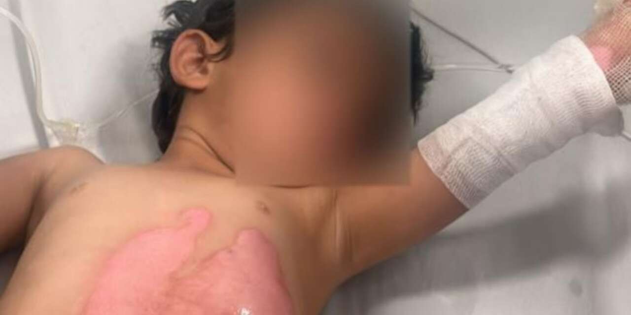 3 yaşındaki çocuğun üzerine kaynar su döküldü