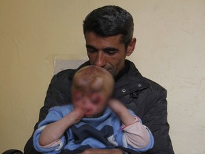 Minik Serkan yüz nakli bekliyor