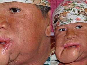 Çenesinde çıkan sivilce hayatını kararttı!