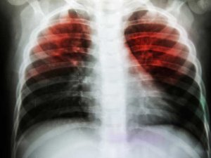 Tüberküloz hastalığının belirtileri nelerdir?