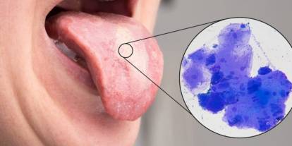 Candida Mantarı: Tanı ve Tedavi Süreci