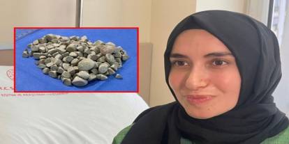 Genç kadının vücudundan 287 tane taş çıkarıldı